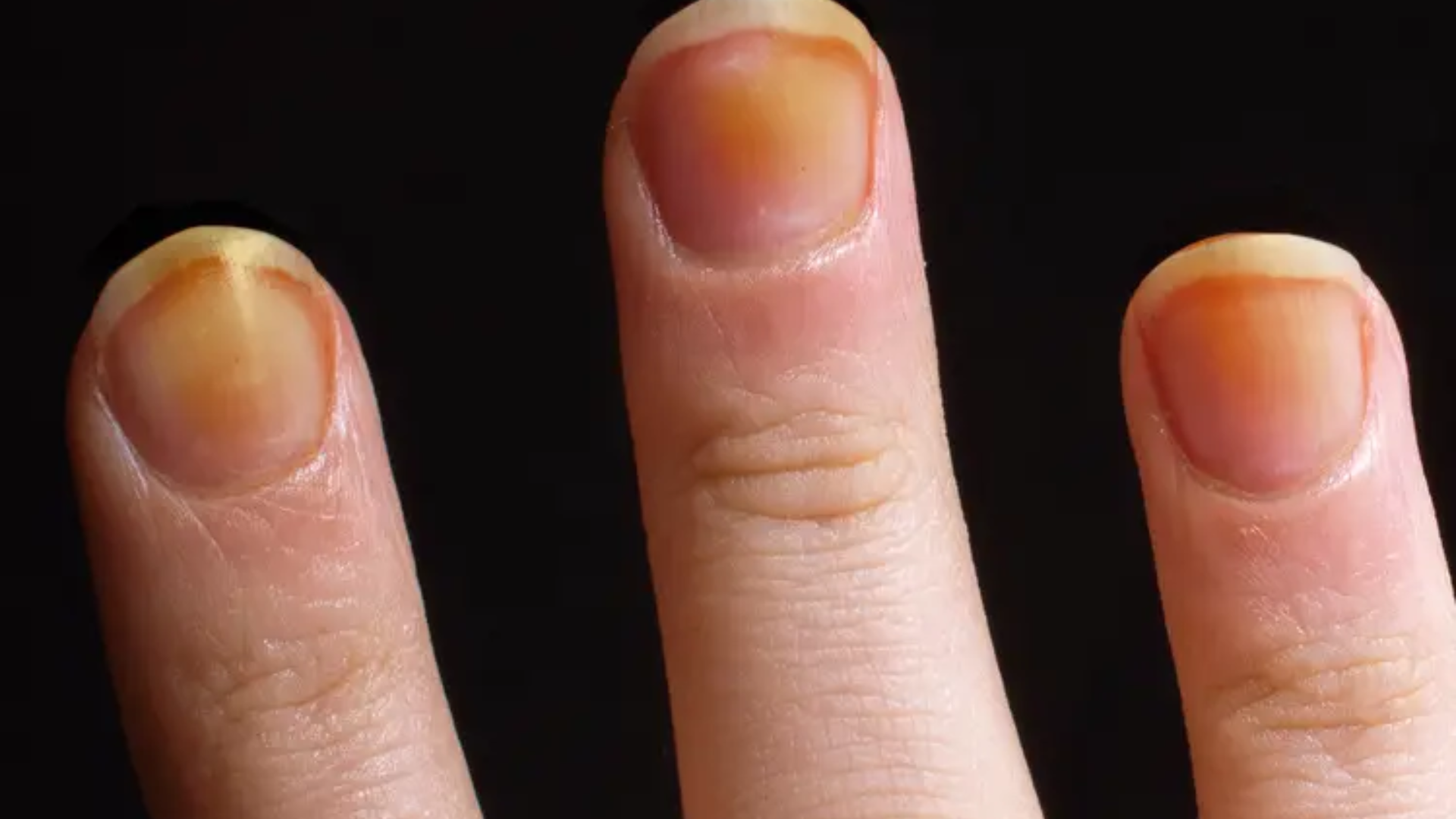 Móng tay chuyển vàng có thể liên quan nhiễm nấm, thói quen hút thuốc hoặc các bệnh phổi kéo dài