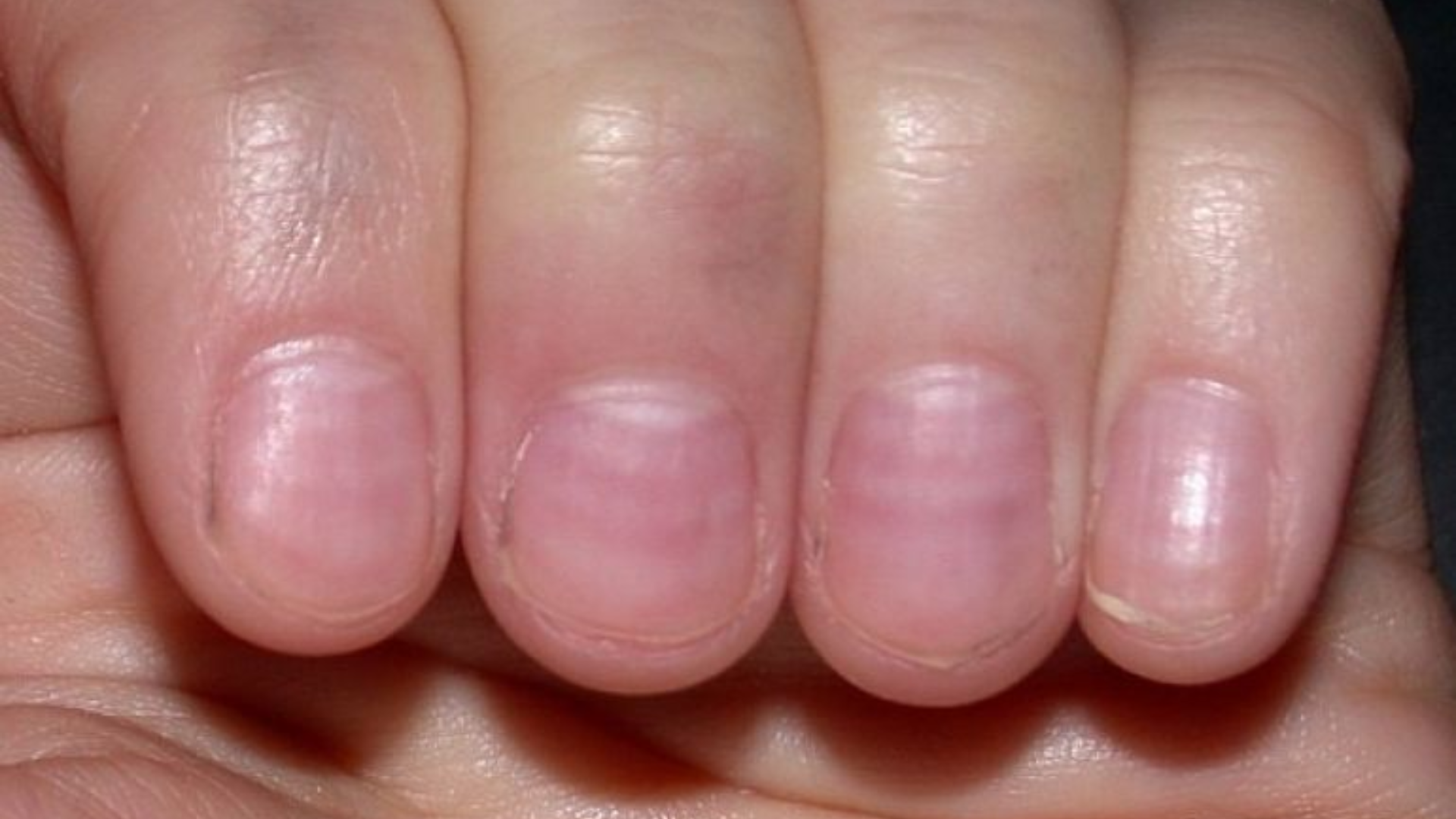 Sọc ngang móng xuất hiện sau stress, bệnh nặng, thiếu dinh dưỡng, rồi sẽ mờ dần khi móng mọc