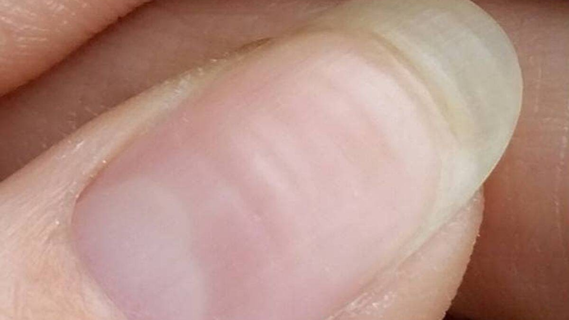 Móng tay bị sọc ngang hình thành từ chân móng, sẽ dần trôi ra đầu móng theo tốc độ mọc tự nhiên