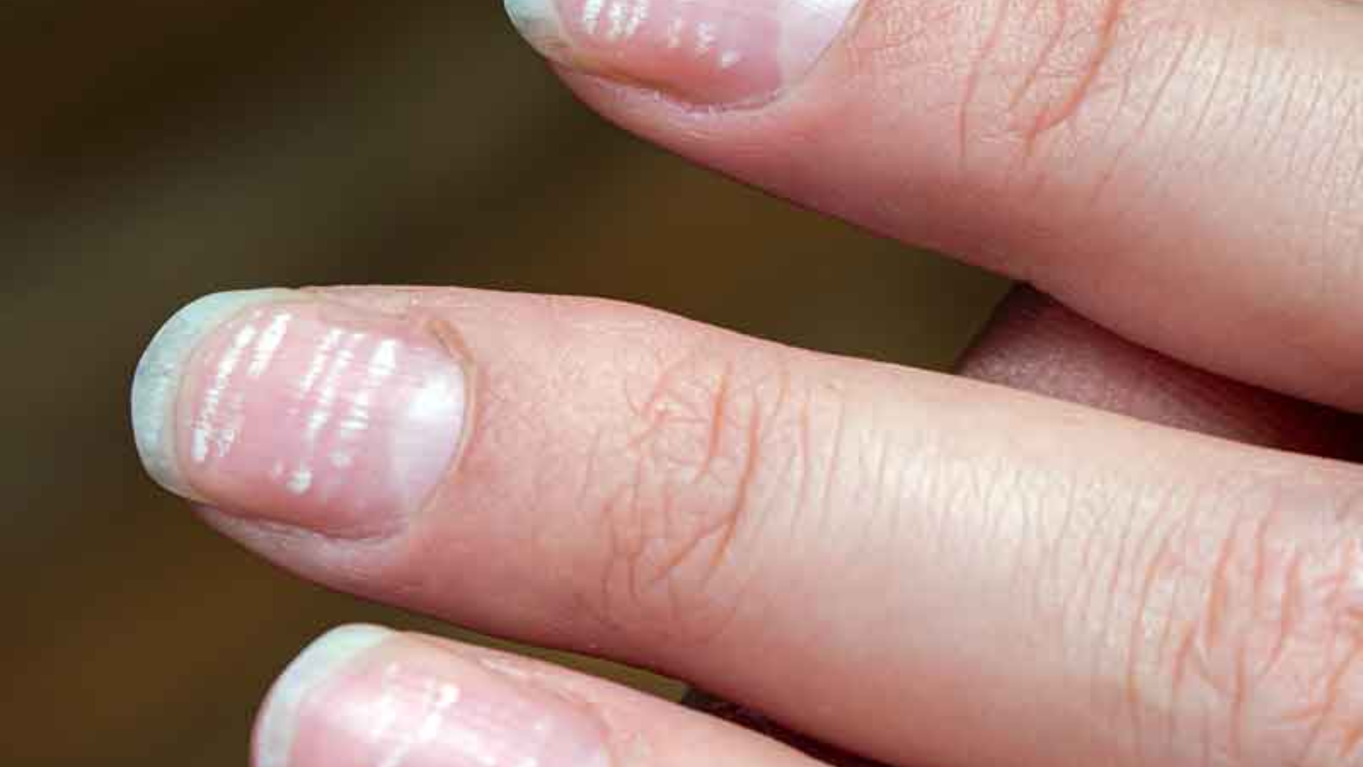 Móng tay bị sọc trắng xuất hiện nhiều kiểu khác nhau, nhận diện đúng giúp tránh lo lắng không cần thiết