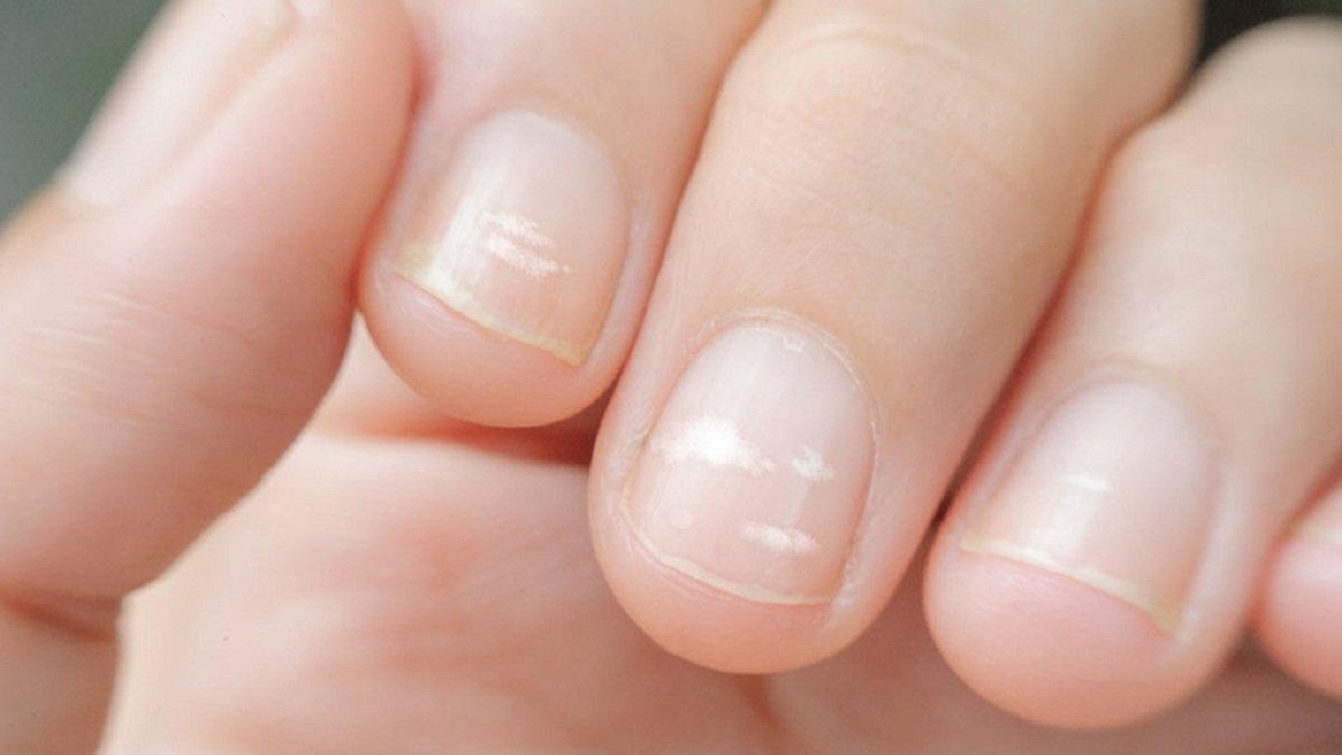 Thiếu kẽm có thể là nguyên nhân dẫn đến hiện tượng móng tay màu trắng đục