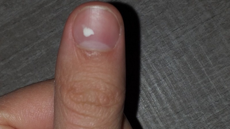 Móng tay trẻ có đốm trắng có thể là do nhiễm nấm móng