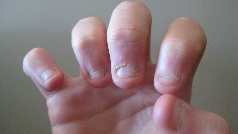 Móng tay trẻ có đốm trắng thường là hiện tượng bình thường