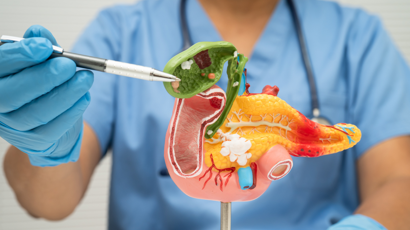 Sỏi mật hình thành do sự kết tinh và tích tụ của các thành phần cặn lắng bên trong túi mật