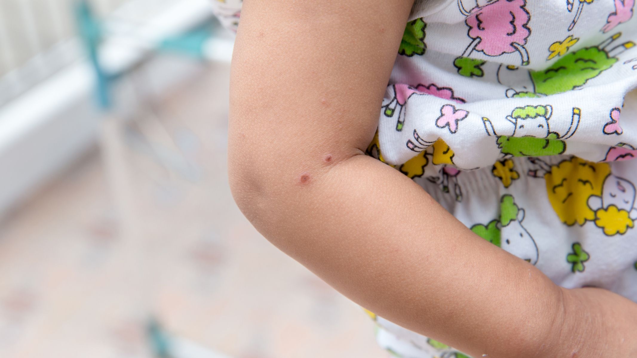 Mùa tay chân miệng cao điểm vào tháng mấy?