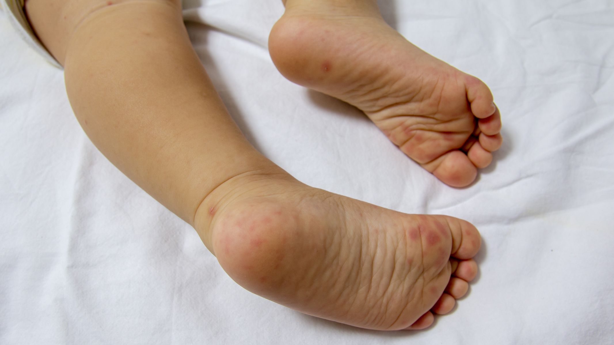 Phụ huynh cần chú ý các dấu hiệu sớm như sốt, loét miệng, phát ban dạng mụn nước ở tay, chân trẻ