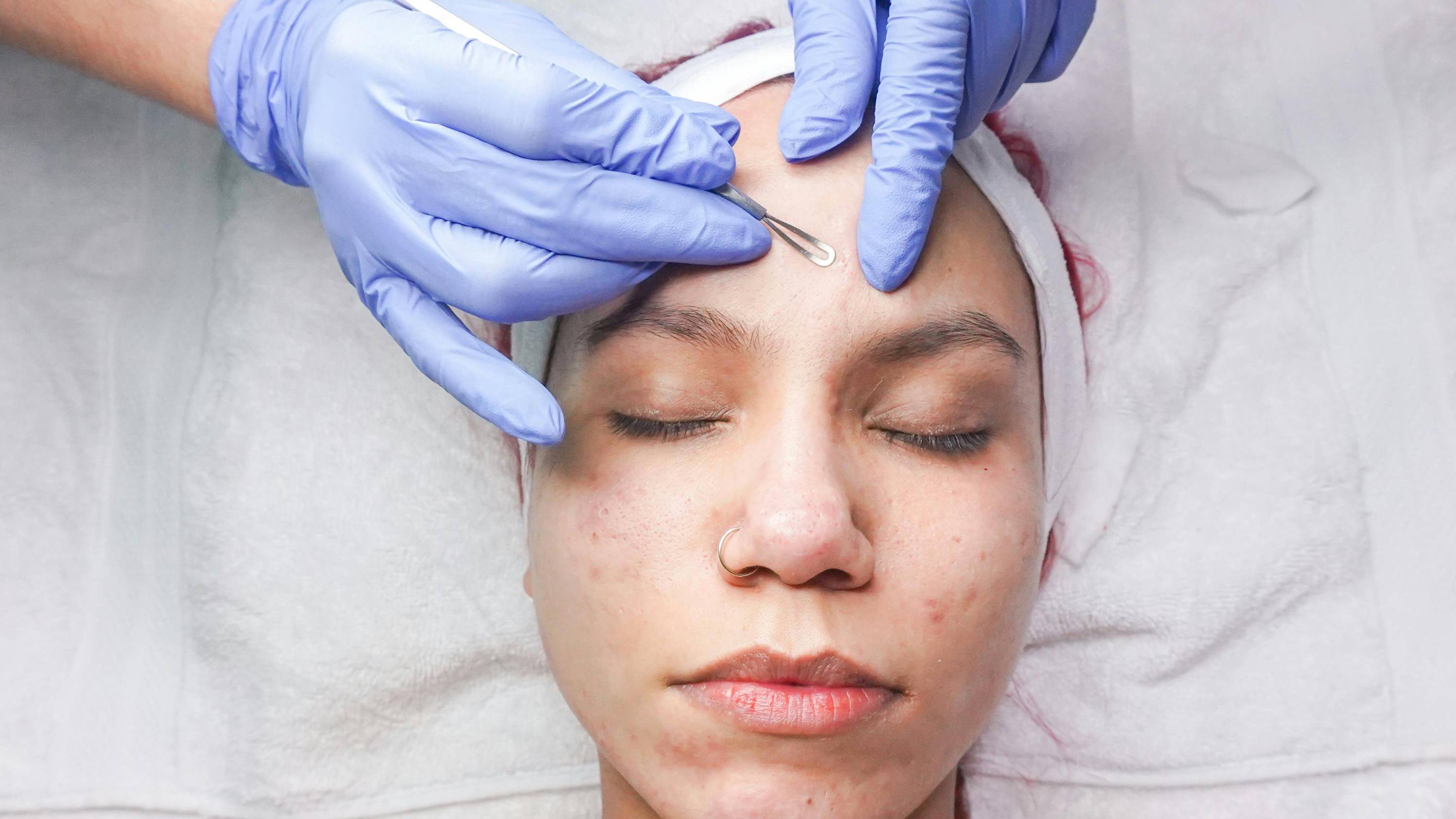 Mụn ẩn trên trán là những nhân mụn nhỏ nằm sâu trong nang lông, mọc thành từng cụm