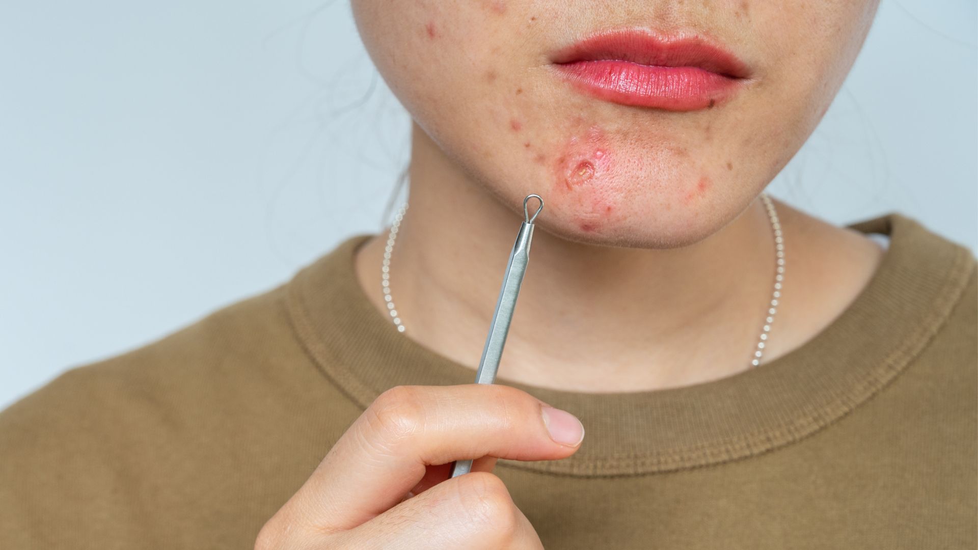 Mụn bọc ở cằm thường biểu hiện bằng nốt sưng viêm đỏ, đau và dễ để lại sẹo nếu xử lý sai cách