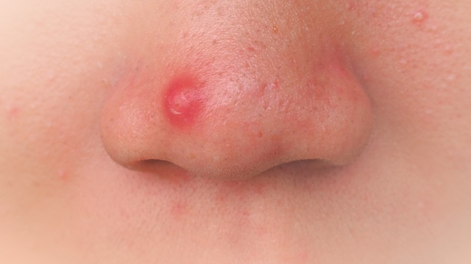 Mụn bọc ở mũi giai đoạn nặng gây sưng to, đỏ lan cánh mũi, đau nhức và nóng rát