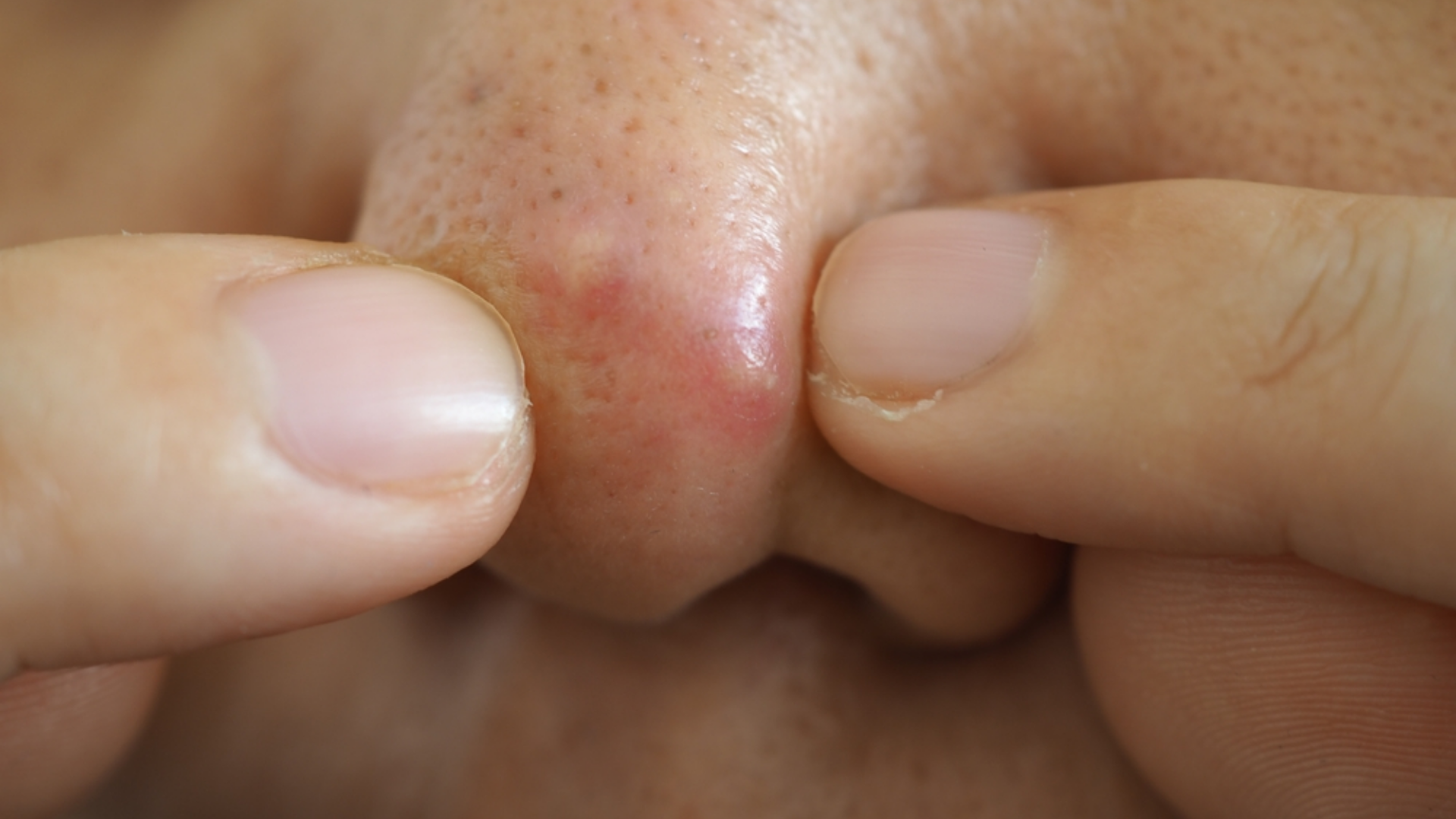 Sờ tay lên mũi thường xuyên và nặn mụn sai cách khiến mụn bùng phát