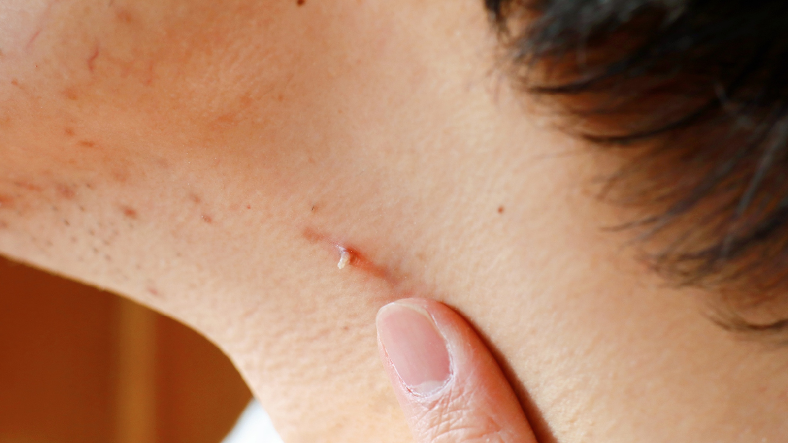 Mụn cóc có thể tự biến mất nếu miễn dịch tốt