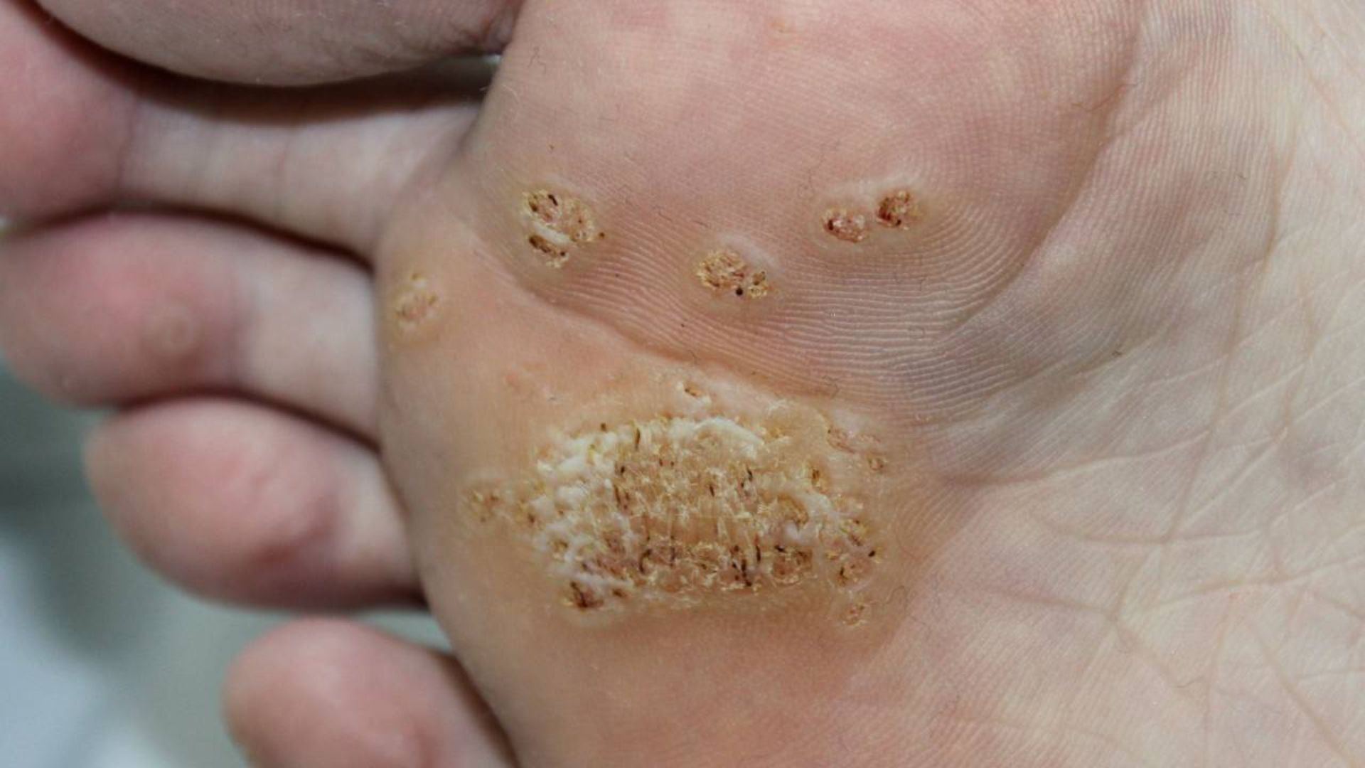 Mụn Cóc Có Tự Hết Không? Khi Nào Cần Dùng Thuốc Điều Trị?