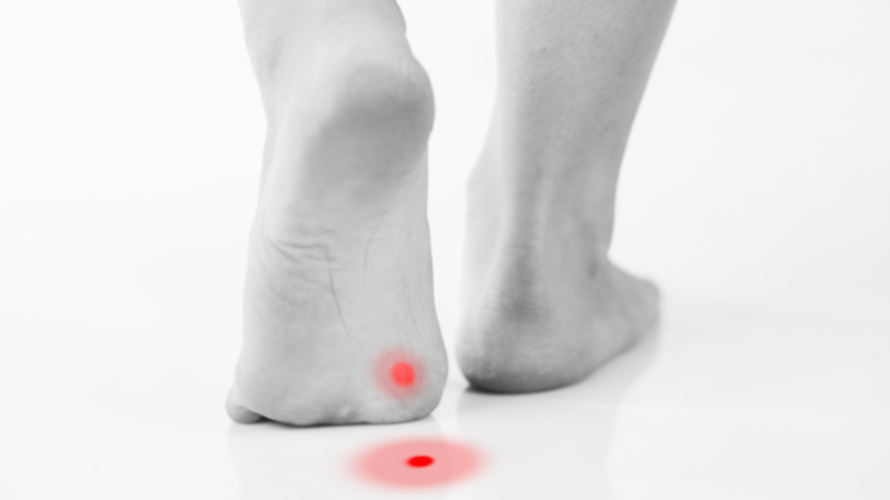 Mụn cóc ở chân gây đau nhức và ảnh hưởng đến việc đi lại