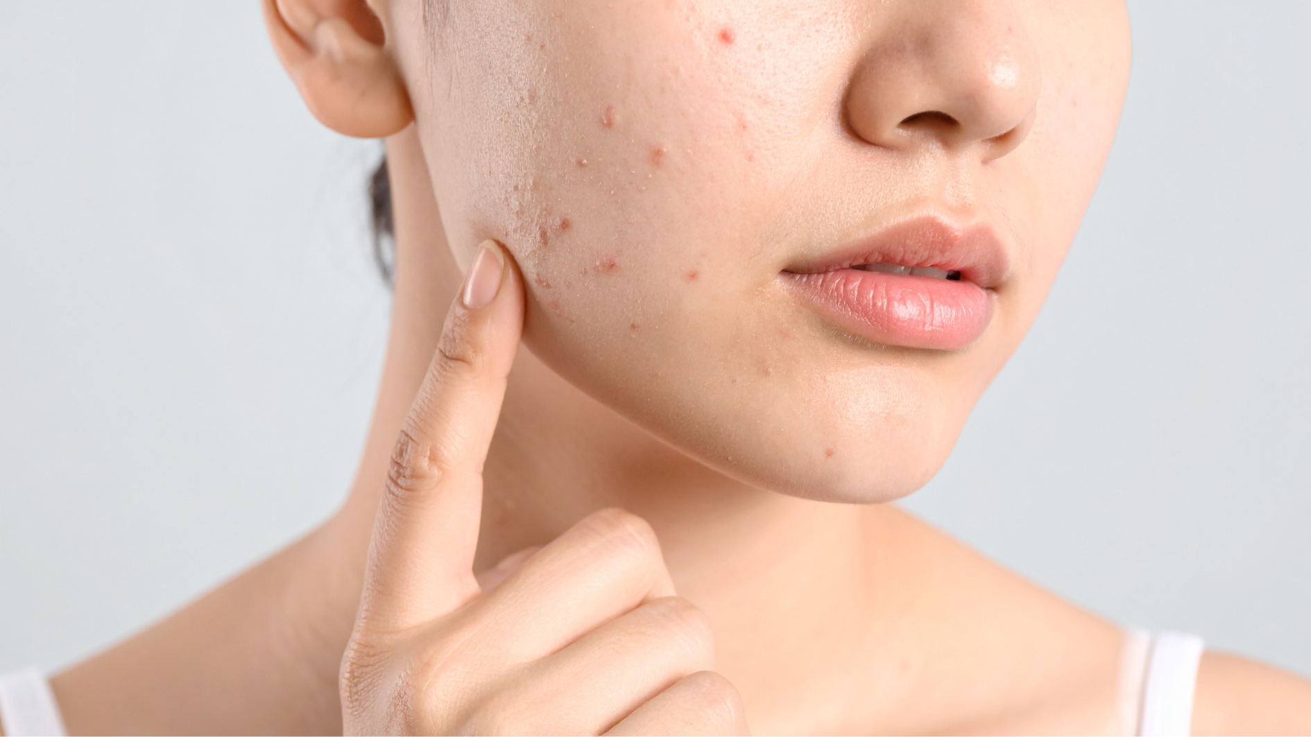 Mụn đầu đen để lâu có thể trở thành mụn viêm