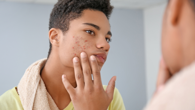 Mụn dị ứng: Dấu hiệu, nguyên nhân và cách xử lý hiệu quả 1