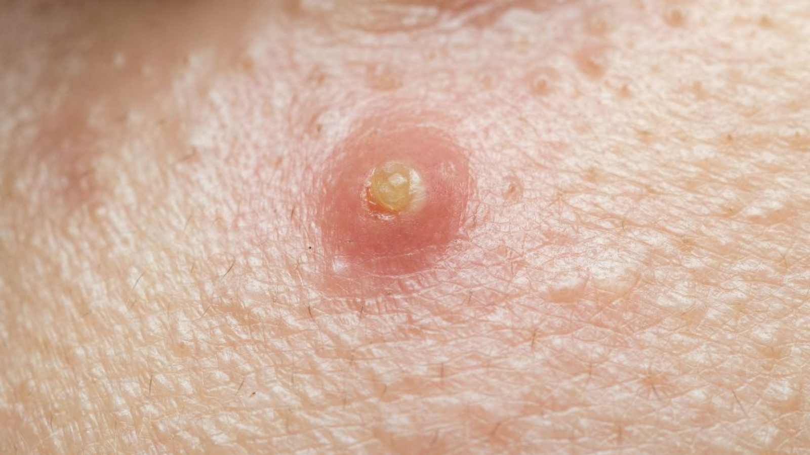 Truyệ đối không tự ý nặn hay chích mụn đinh râu