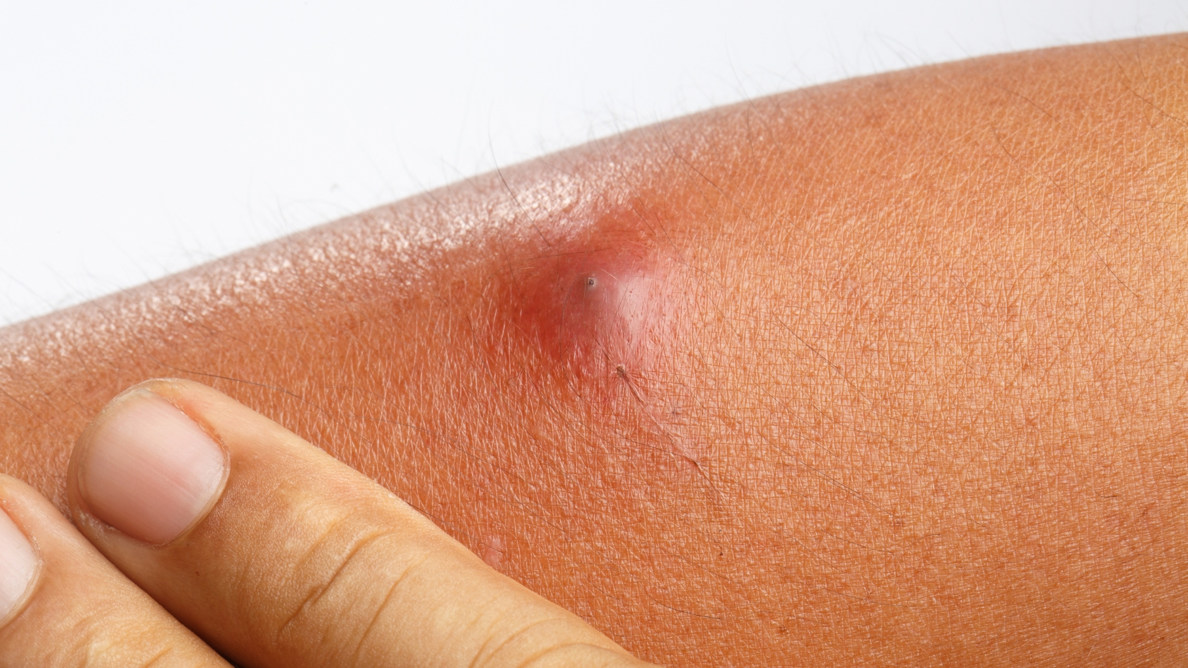 Mụn đinh râu tạo ổ mủ ở trung tâm và hình thành một ngòi cứng màu sẫm, trông giống đầu đinh