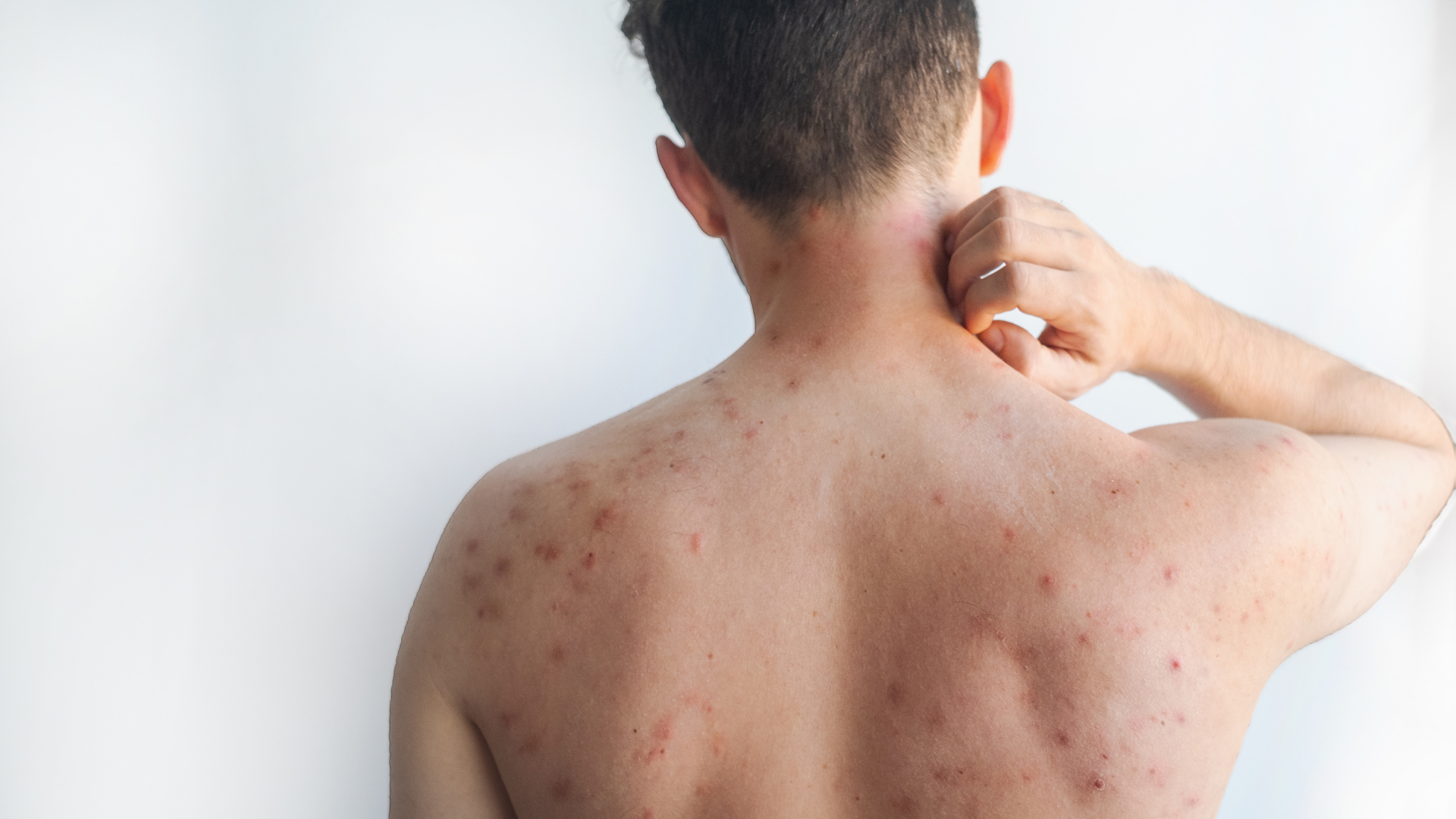 Khi nào cần xét nghiệm nếu nghi ngờ mụn HIV giai đoạn đầu?