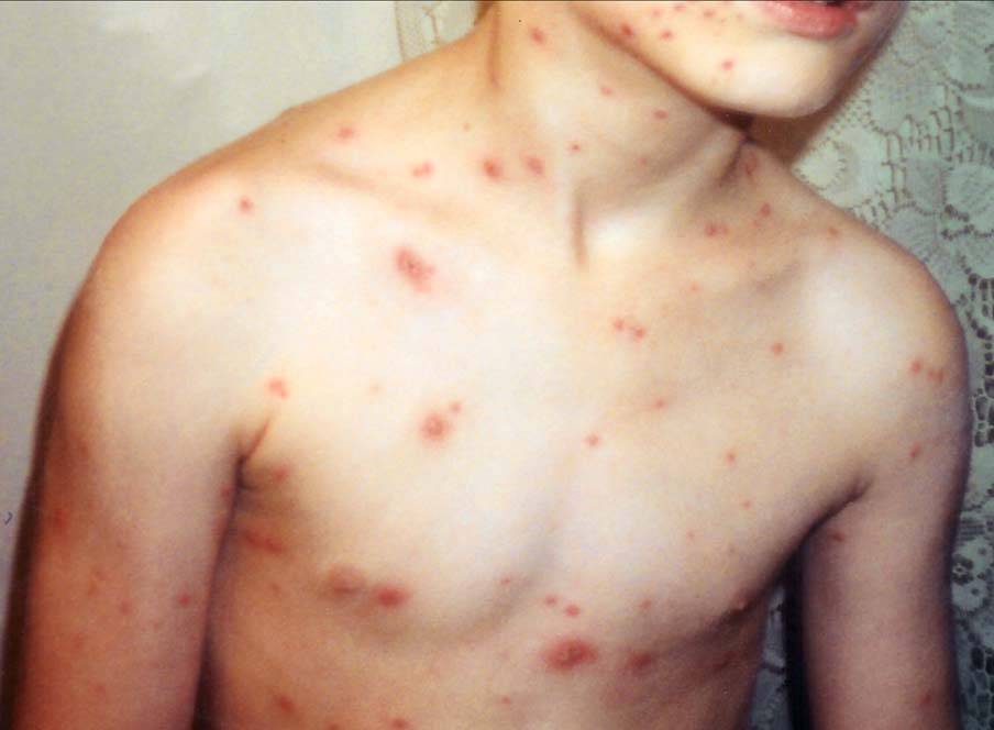 Mụn HIV là gì? Phân biệt mụn HIV và mụn thông thường 1