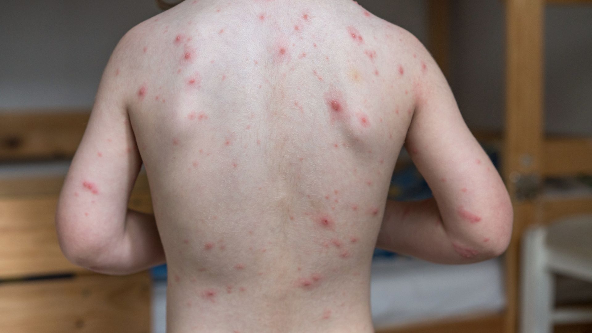 Mụn HIV là gì? Phân biệt mụn HIV và mụn thông thường 1