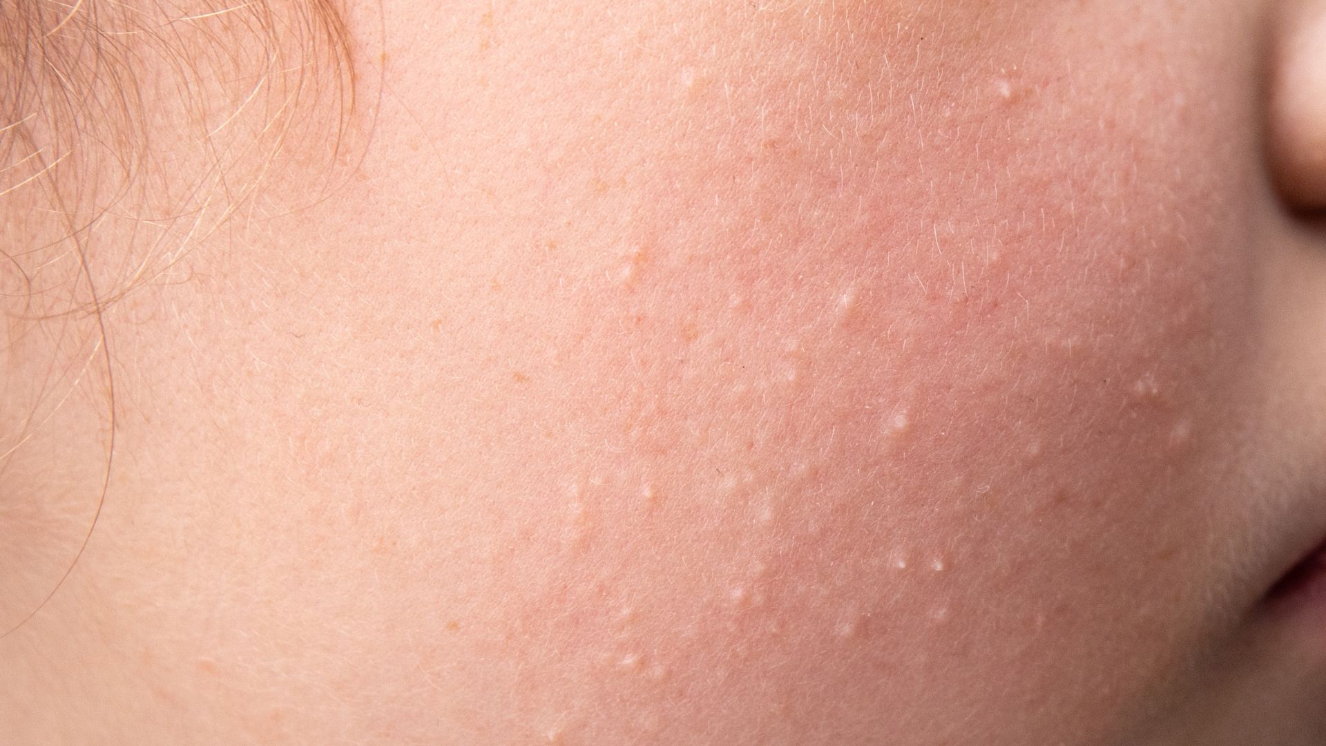 Hình ảnh mụn kê ở trẻ sơ sinh với các nốt nhỏ màu trắng li ti trên mặt