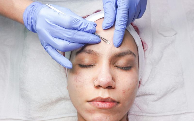 Nặn mụn đúng cách và đảm bảo vô trùng giúp tình trạng cải thiện tốt hơn