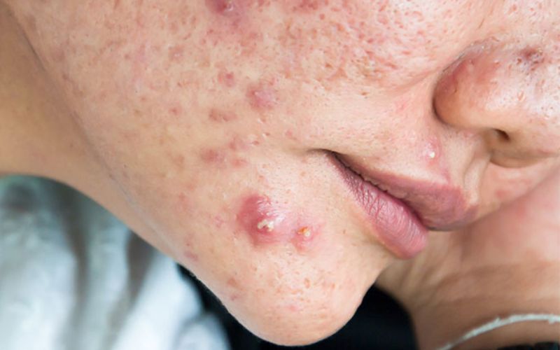 Nặn mụn không đúng cách có thể gây nhiễm trùng nặng hơn, để lại sẹo lồi lõm mất thẩm mỹ