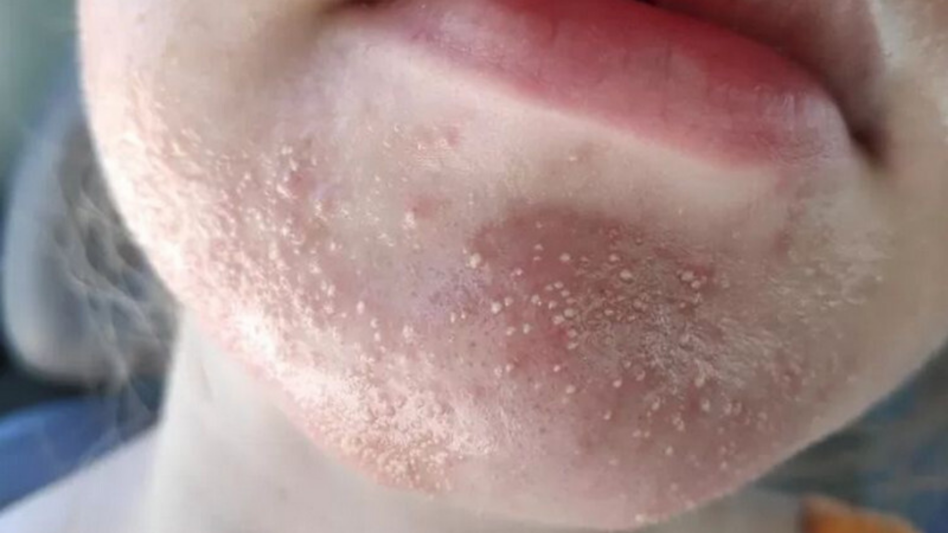 Mụn nấm men là viêm nang lông do nấm Malassezia phát triển quá mức trên da