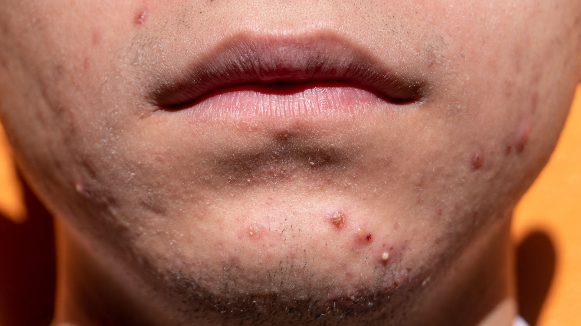 Mụn nấm men do nấm gây ngứa nhiều, mụn trứng cá do vi khuẩn thường đau và sưng