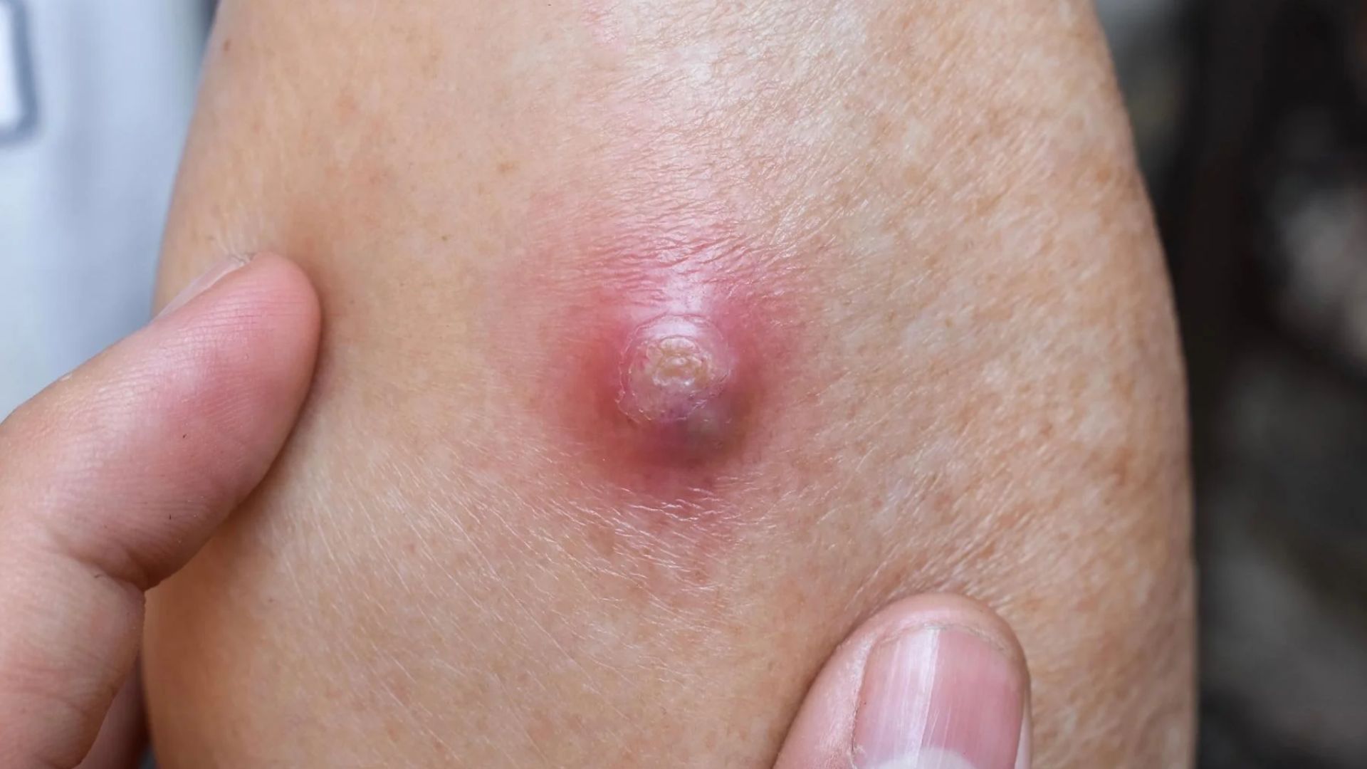 Mụn nhọt là gì? Nguyên nhân, triệu chứng và cách điều trị 2
