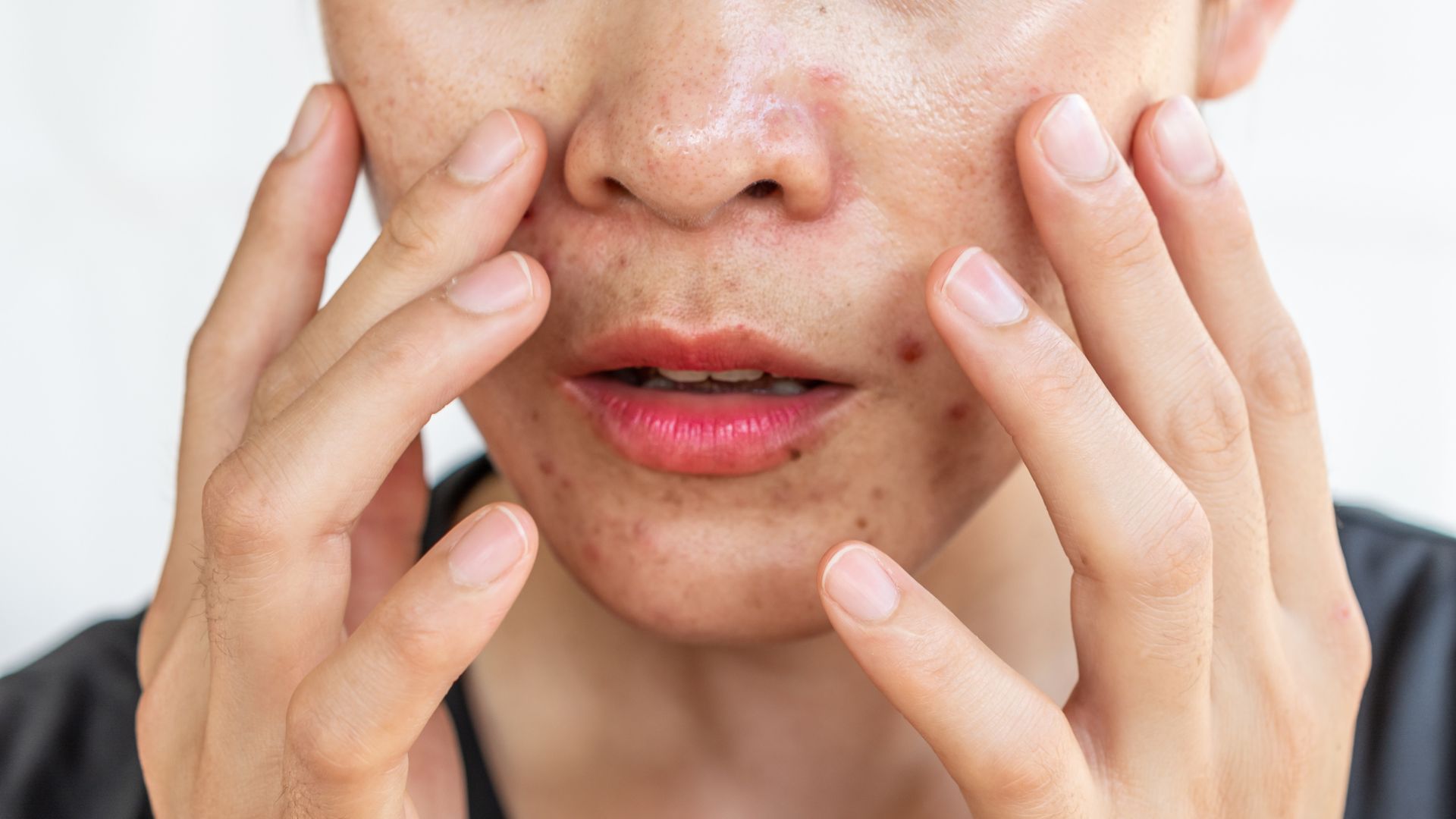 Mụn nhọt bị nhiễm trùng: Nhận biết sớm và chăm sóc đúng cách để tránh biến chứng 4
