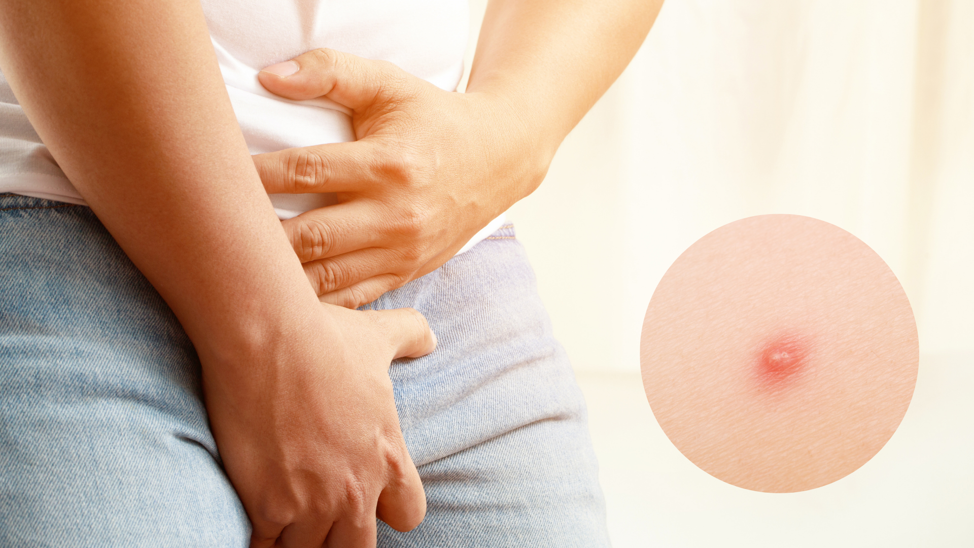 Mụn nhọt ở háng: Cần đối phó như thế nào để tránh biến chứng? 2