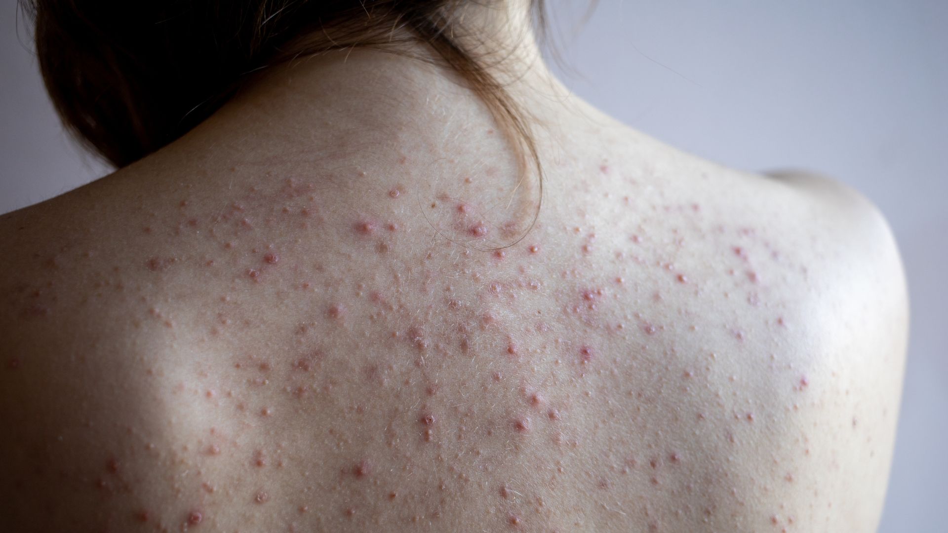 Mụn nhọt ở lưng: Bệnh ngoài da thường gặp và cách xử lý 1