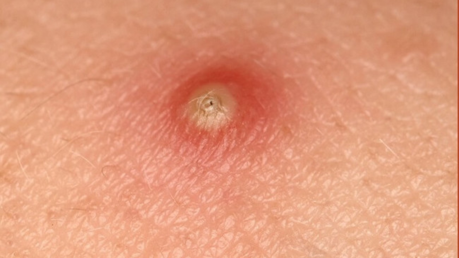 Mụn nhọt ở mông xuất hiện nốt sưng đỏ cứng đau khi ngồi hoặc chạm, da xung quanh nóng và tấy lên