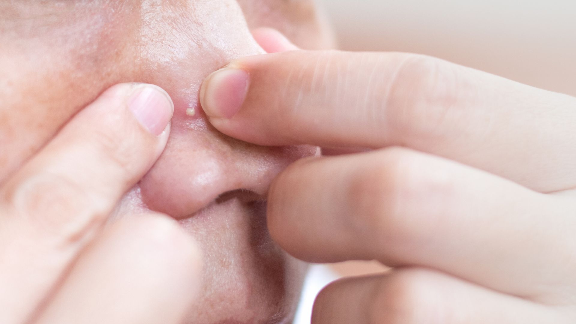 Mụn nhọt ở mũi: Nguyên nhân, dấu hiệu và cách xử lý an toàn, đúng chuẩn y khoa 3