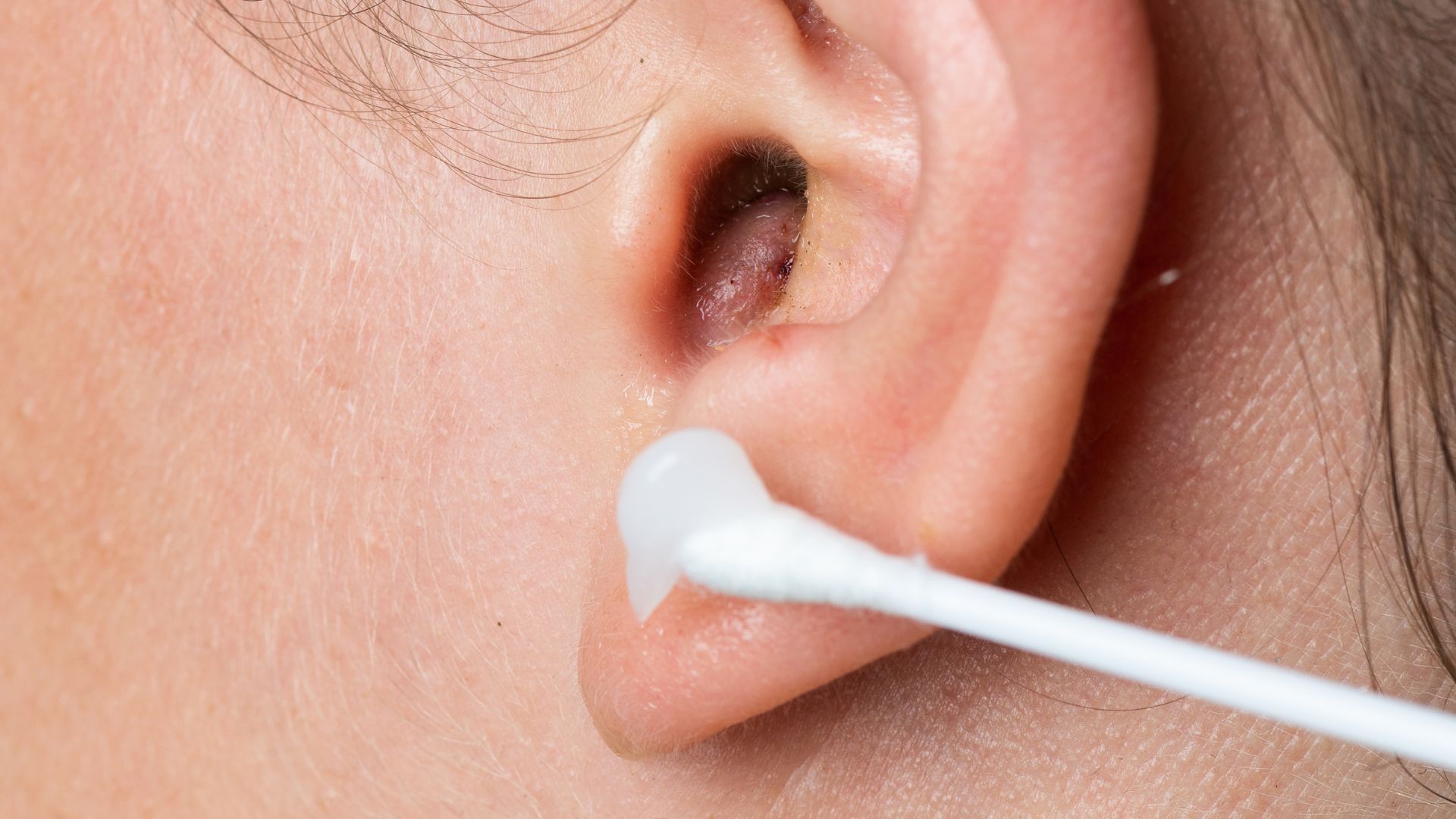 Mụn nhọt ở tai: Cách xử lý an toàn và phòng ngừa tái phát 1