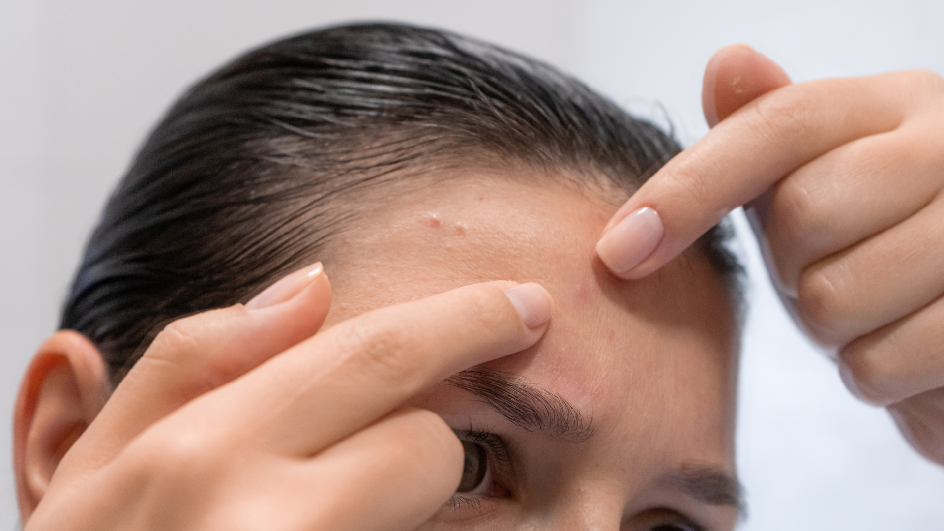 Mụn nhọt ở trán: Nguyên nhân, cách phòng ngừa và khi nào cần đi khám? 4