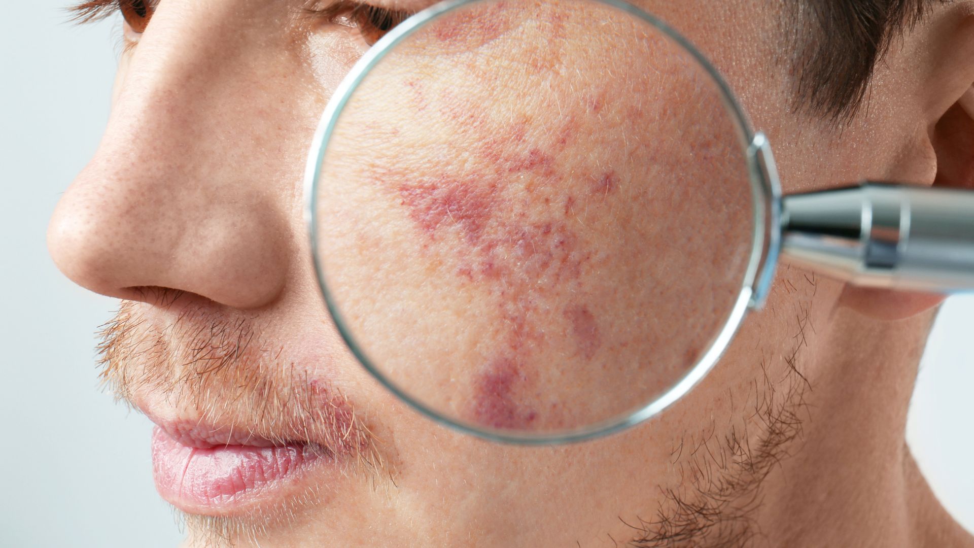 Mụn nhọt và ung thư da: Cách phân biệt đúng để tránh bỏ sót dấu hiệu nguy hiểm 2