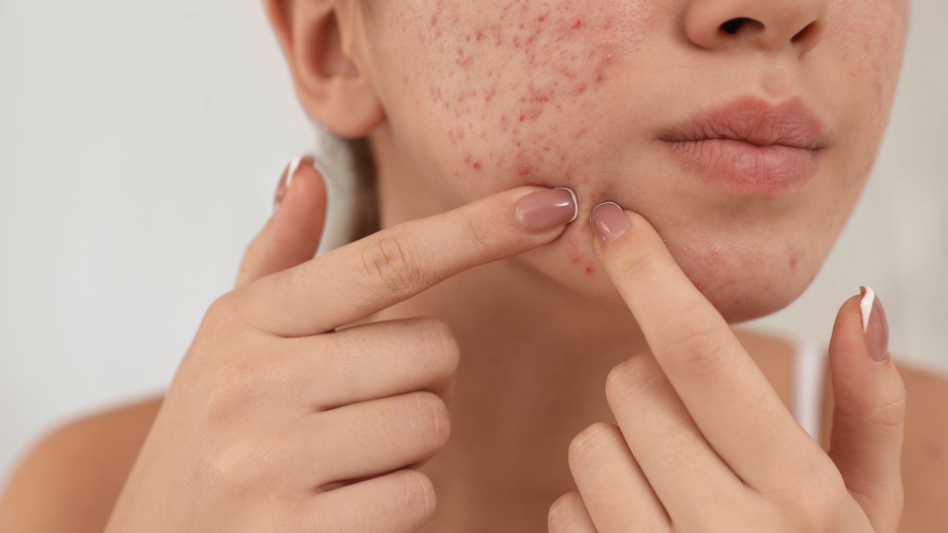 Mụn nội tiết là gì? Nguyên nhân, triệu chứng và cách điều trị hiệu quả-2