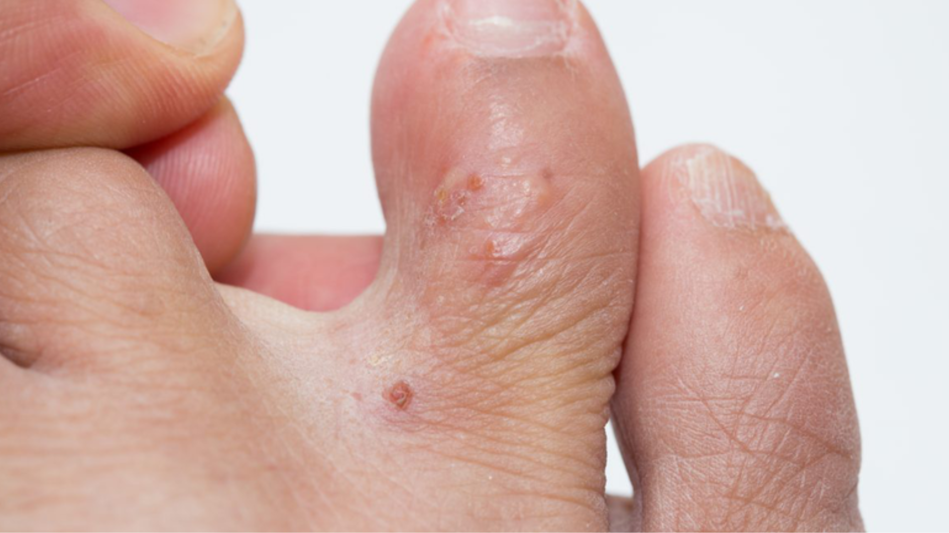 Mụn nước nhỏ thường tự lành trong vài ngày khi chăm sóc đúng cách