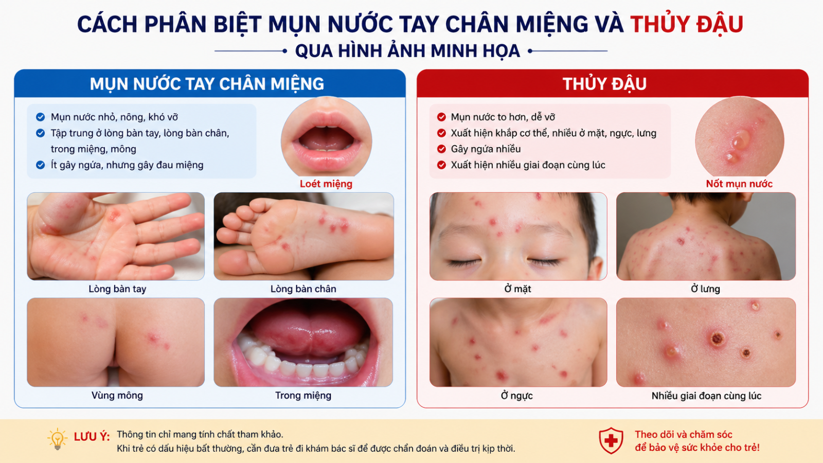 Cách phân biệt mụn nước tay chân miệng và thủy đậu qua hình ảnh minh họa rõ ràng