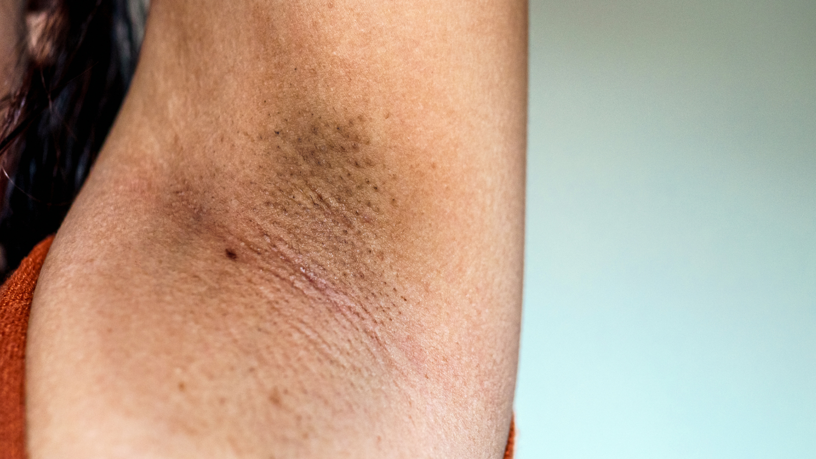 Mụn ở nách có thể là mụn viêm hoặc nhọt, cần phân biệt để điều trị đúng cách