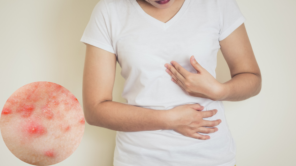 Mụn ở ngực: Nguyên nhân, cách điều trị và phòng ngừa hiệu quả 3