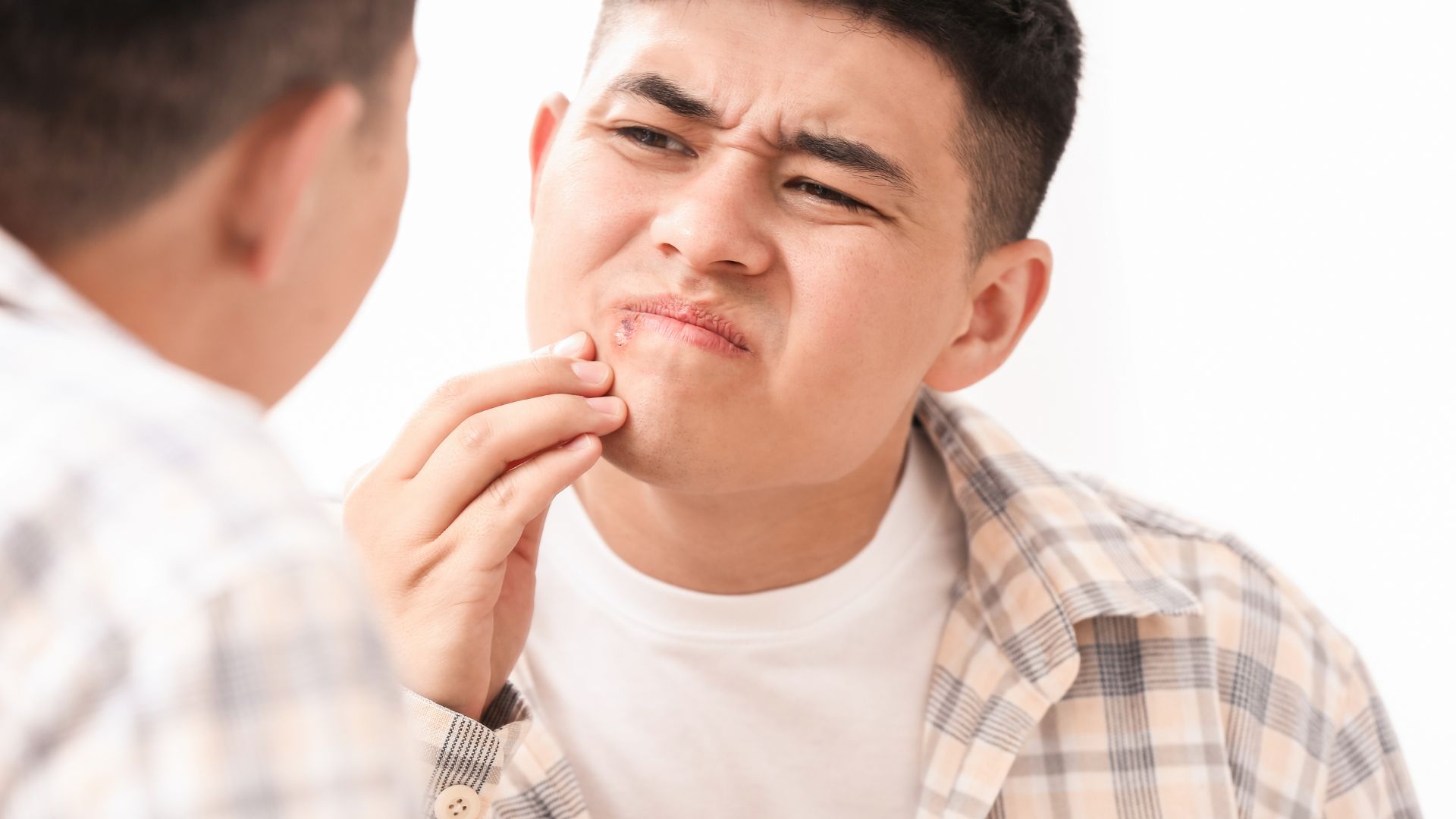 Mụn rộp ở môi do virus Herpes Simplex (HSV-1) gây ra, tạo mụn nước nhỏ và đau rát