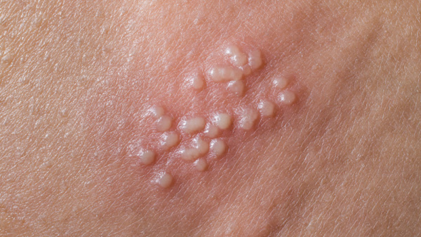 Mụn rộp sinh dục có tự khỏi không? Cách điều trị và phòng bệnh? 2