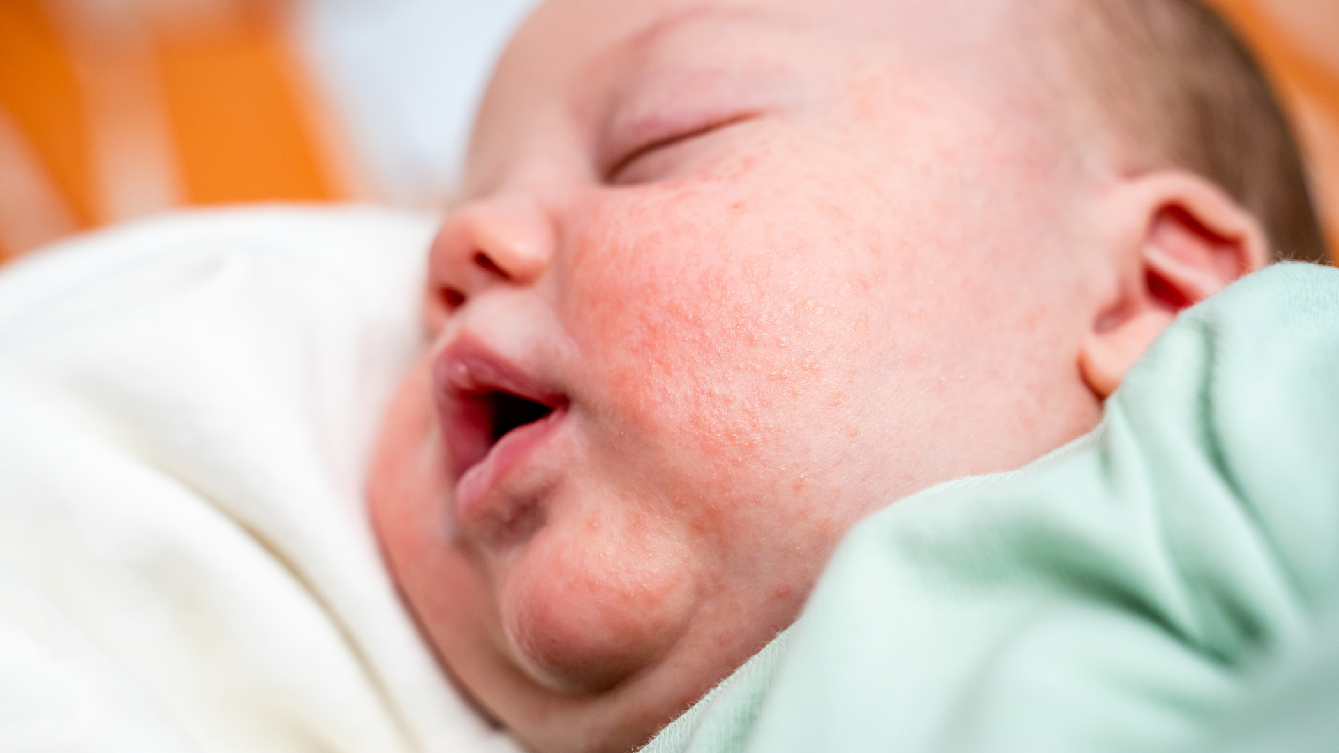 Mụn sữa ở trẻ sơ sinh: Nhận biết và chăm sóc đúng cách cho bé yêu 4