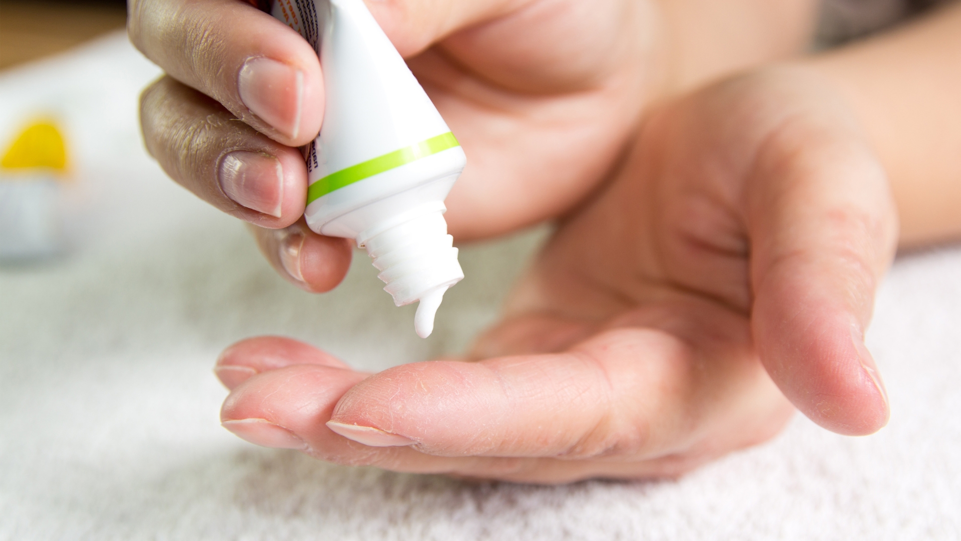 Sau khi được thăm khám và xác định nguyên nhân, bác sĩ có thể chỉ định bệnh nhân sử dụng các loại thuốc bôi thích hợp để điều trị