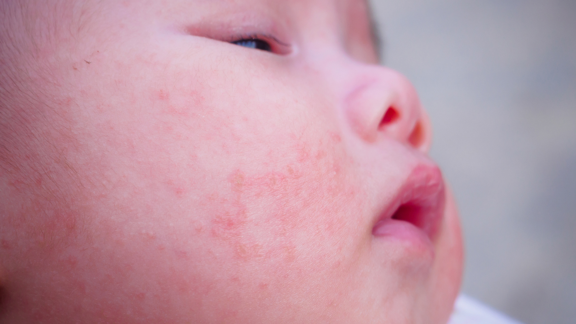 Chăm sóc da nhẹ nhàng khi trẻ bị mụn trứng cá ở trẻ sơ sinh