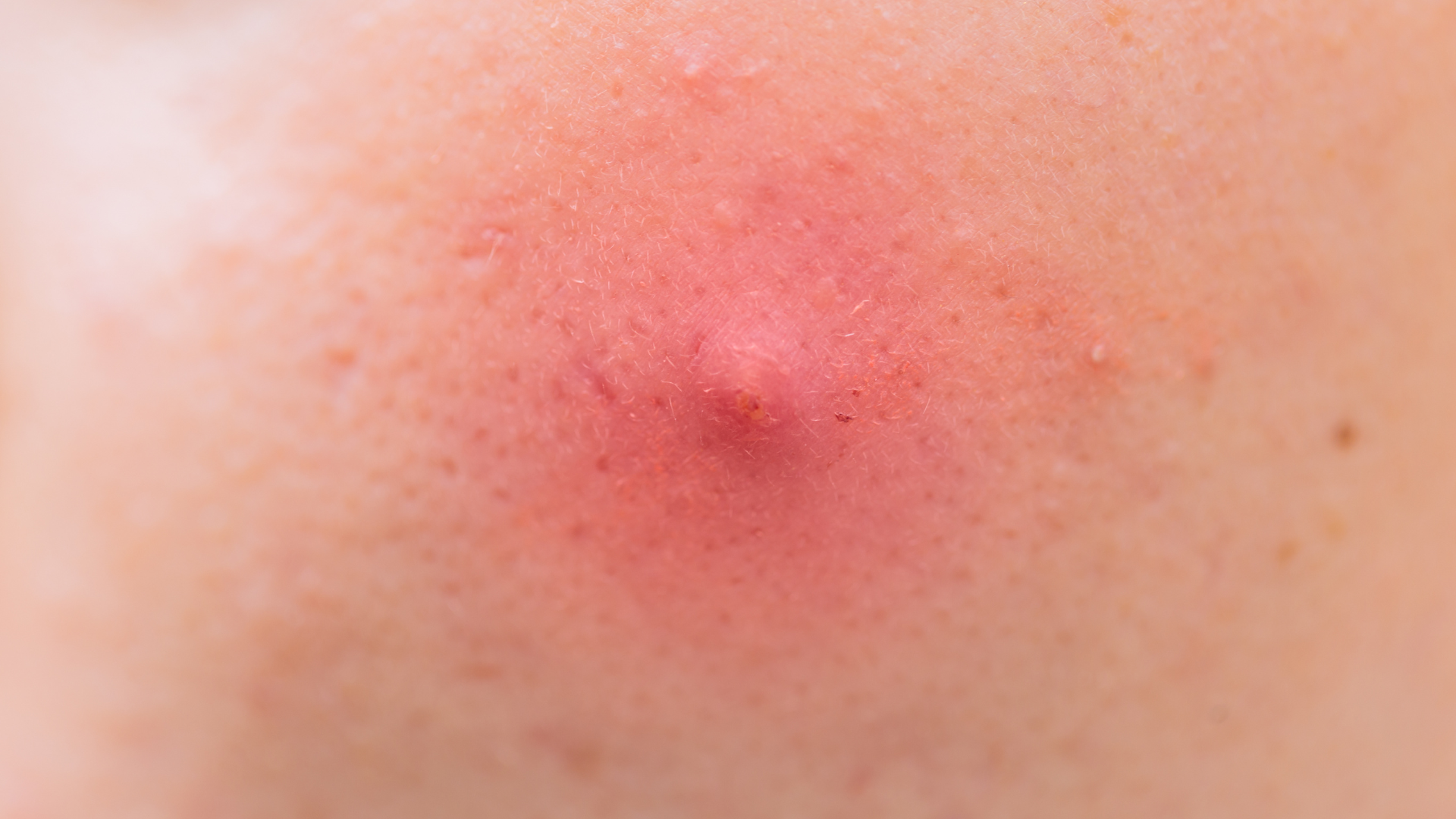 Nhìn đúng loại mụn viêm đỏ để chọn cách xử lý phù hợp