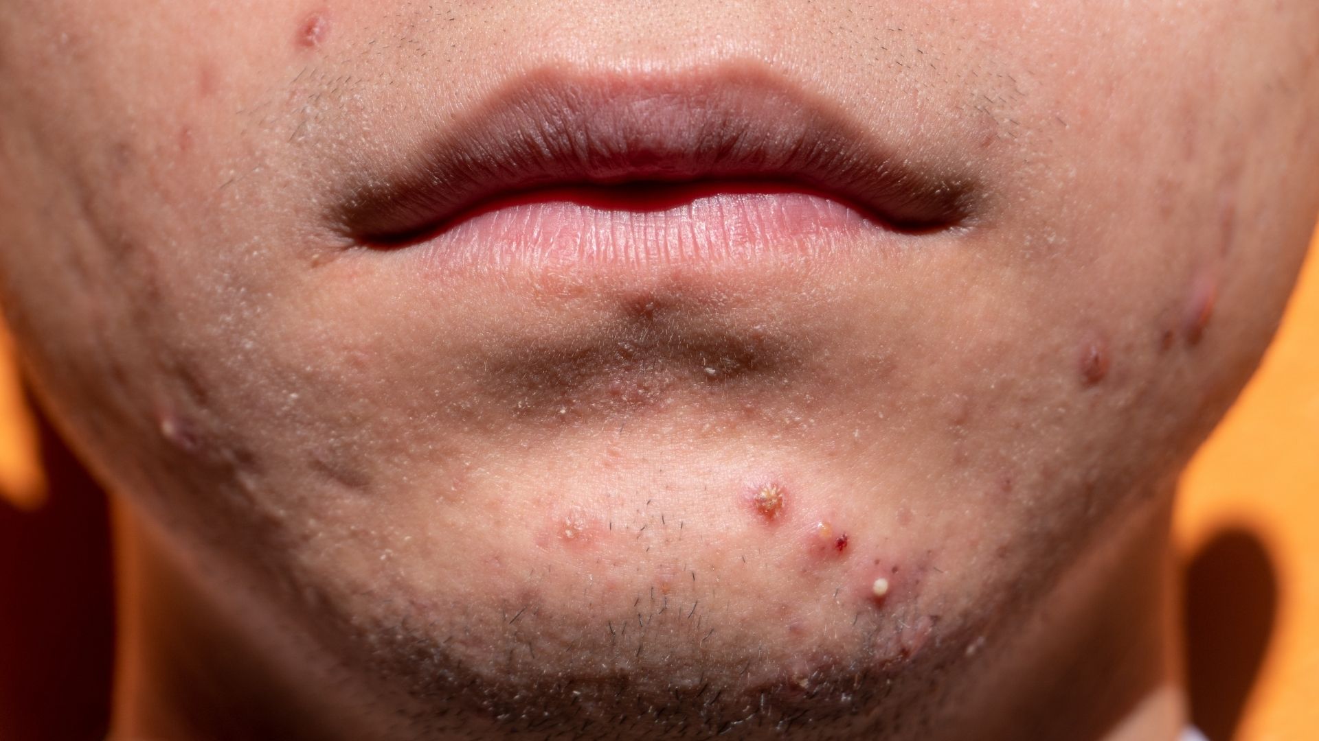 Mụn viêm có nhiều hình thái trên lâm sàng